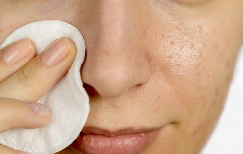 Comment ne pas avoir de boutons sur le visage